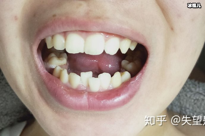 龅牙矫正能够改进突嘴吗？