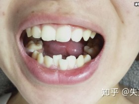 【APT扑克】龅牙矫正能够改进突嘴吗？